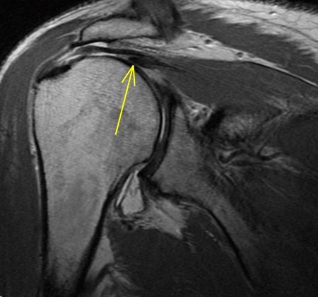 Figure 3 for case Supraspinatus and subscapularis tears involving the anterior rotator cable